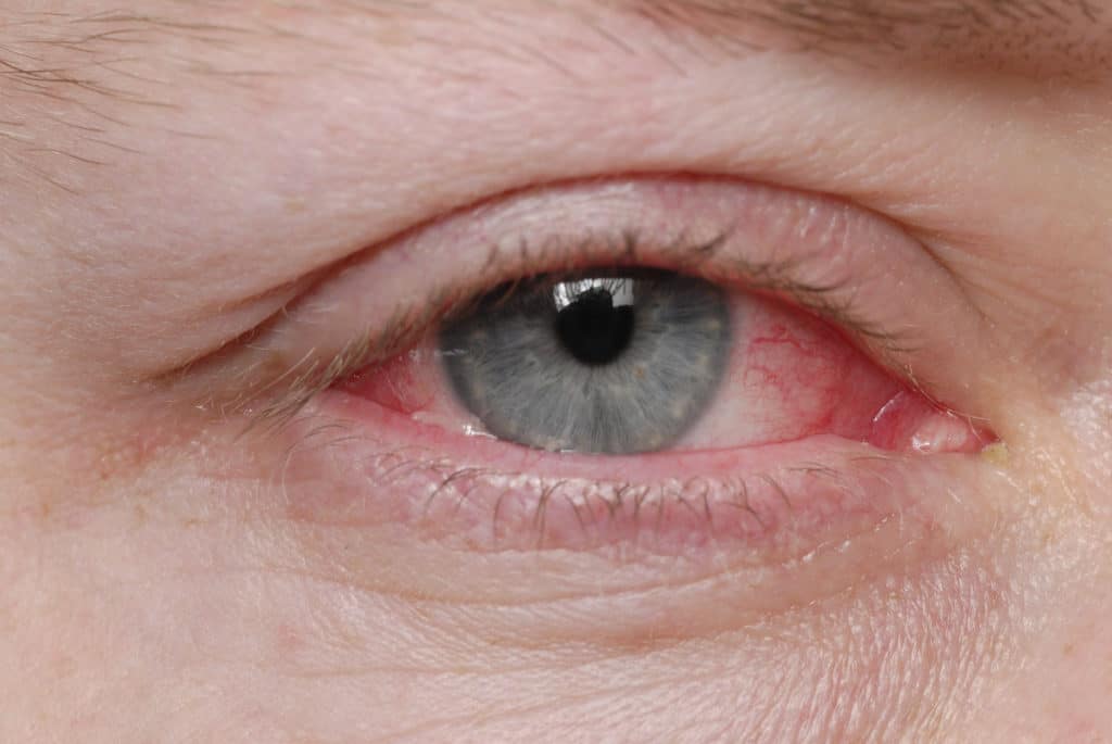 Male patient with pink eye and what pink eye looks like