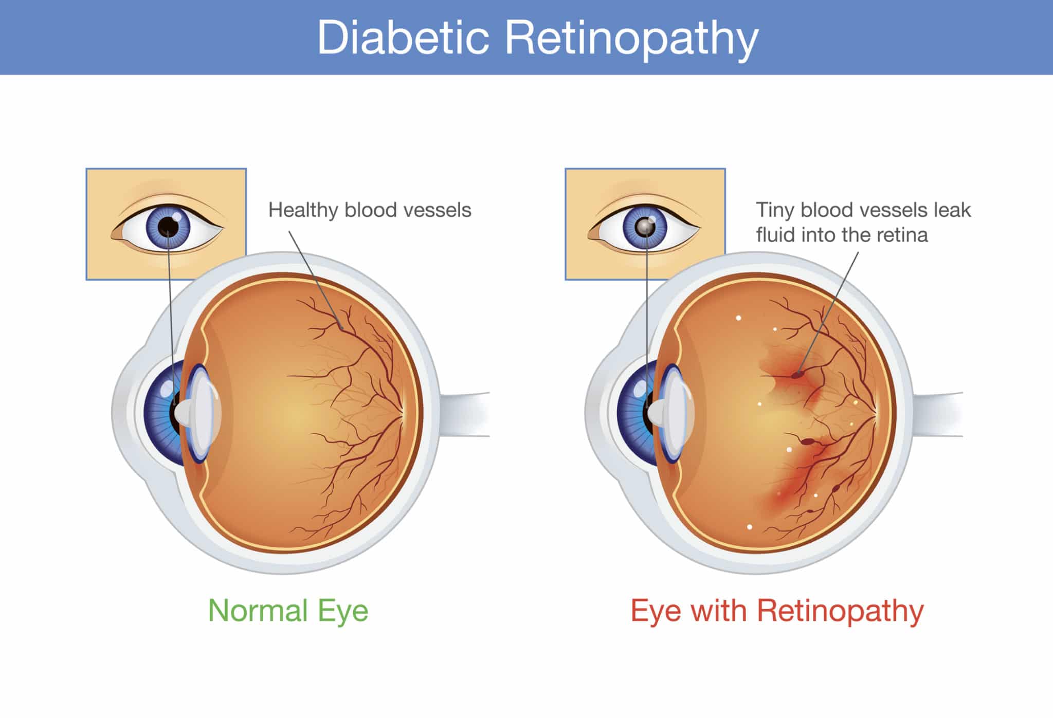 Diabetic Retinopathy North Attleborough MA